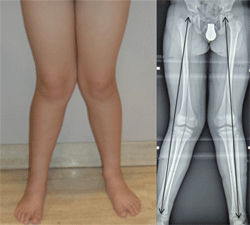 Imagen que muestra las piernas de un niño con las rodillas torcidas hacia adentro